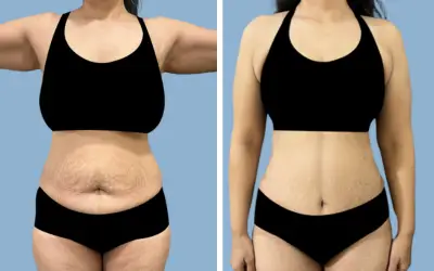 Before and After